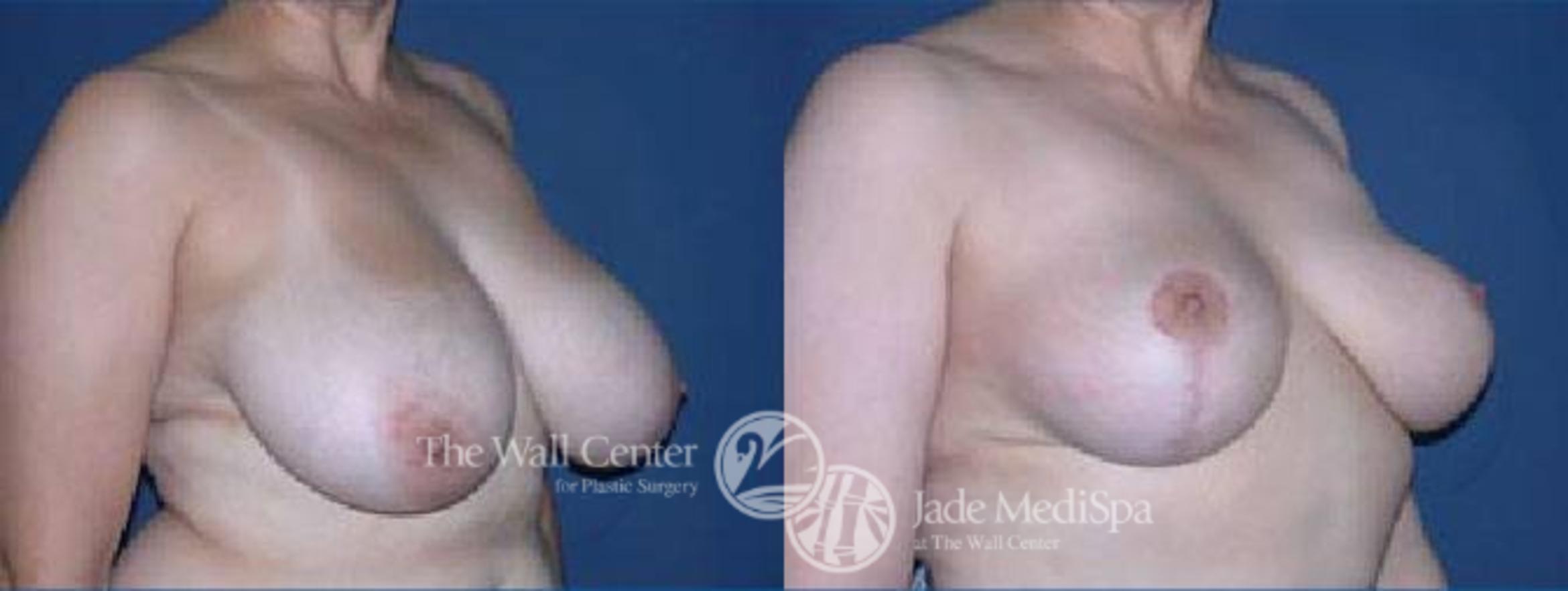 Before & After Breast Reduction Case 67 View #2 View in Shreveport, LA