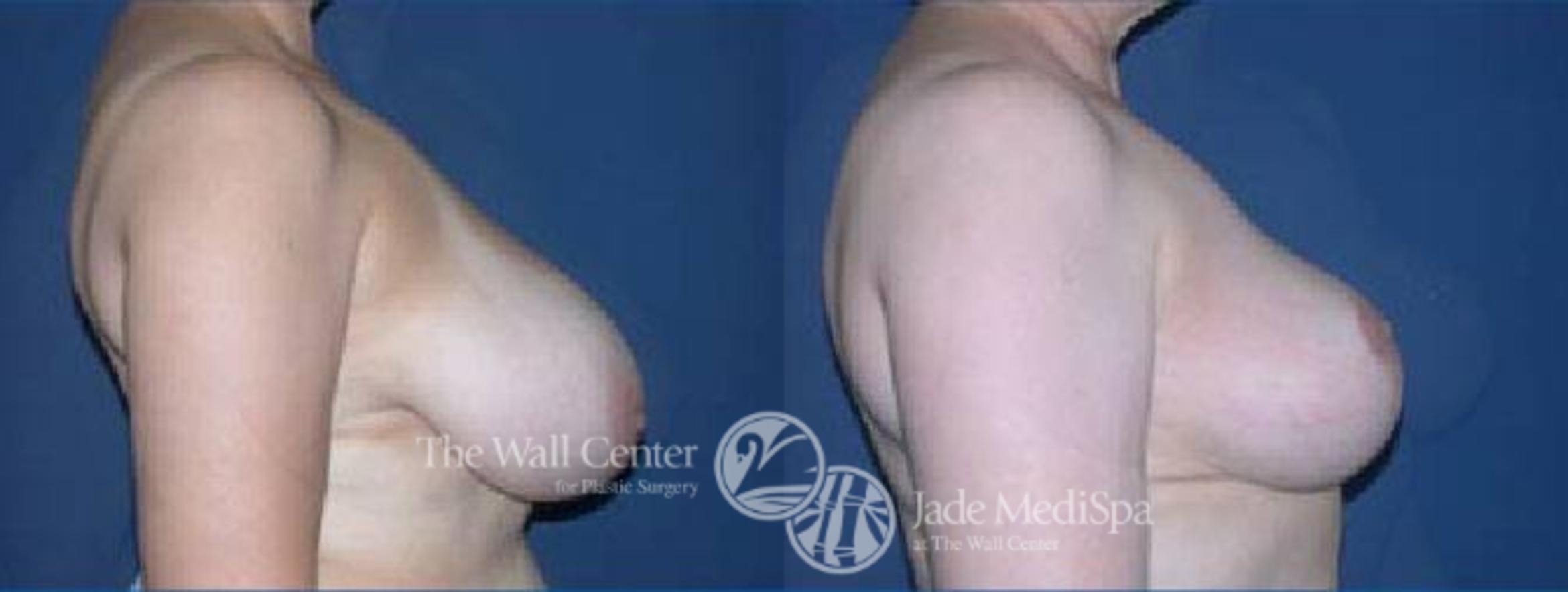 Before & After Breast Reduction Case 67 View #3 View in Shreveport, LA