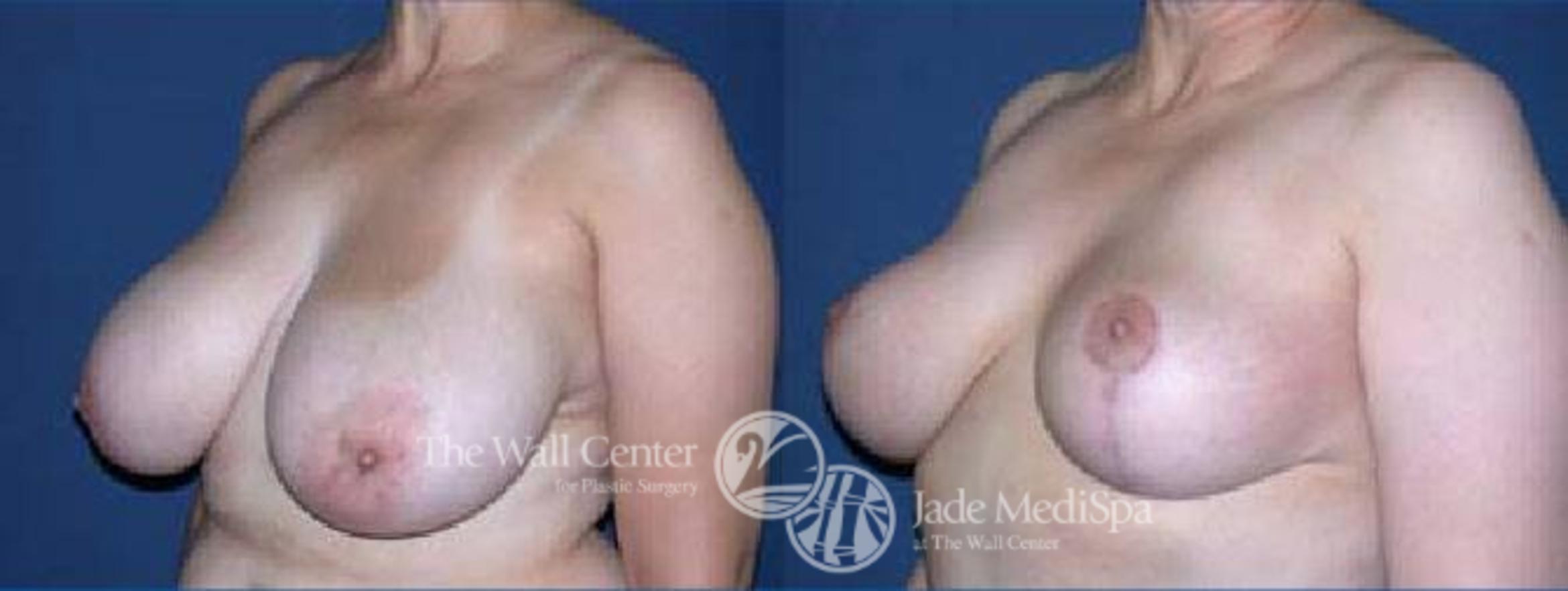 Before & After Breast Reduction Case 67 View #4 View in Shreveport, LA