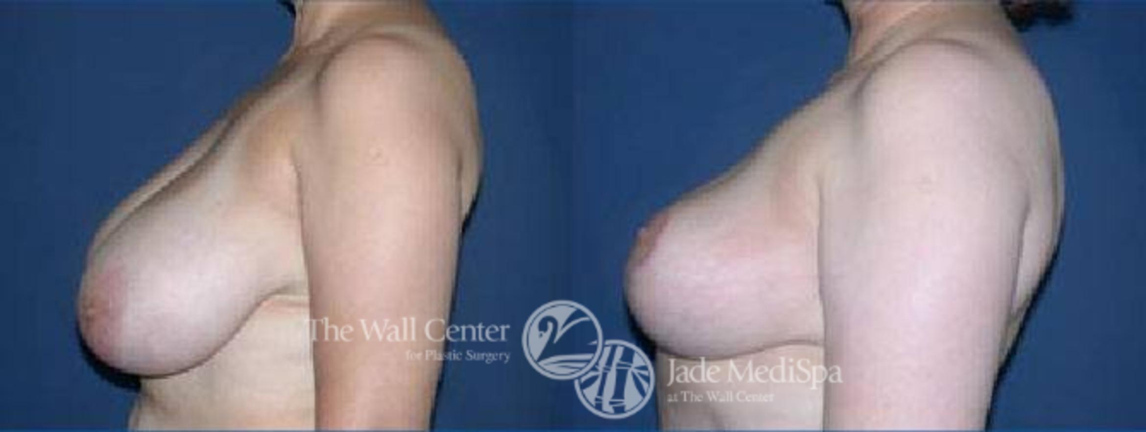 Before & After Breast Reduction Case 67 View #5 View in Shreveport, LA