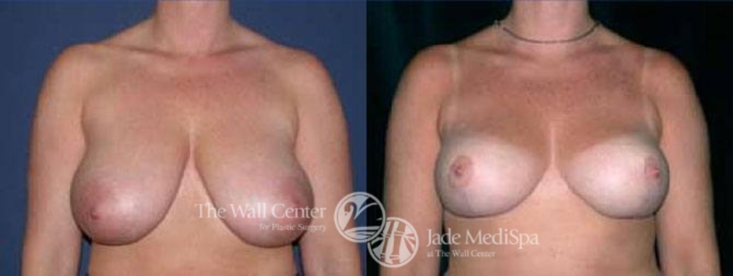 Before & After Breast Reduction Case 69 View #1 View in Shreveport, LA