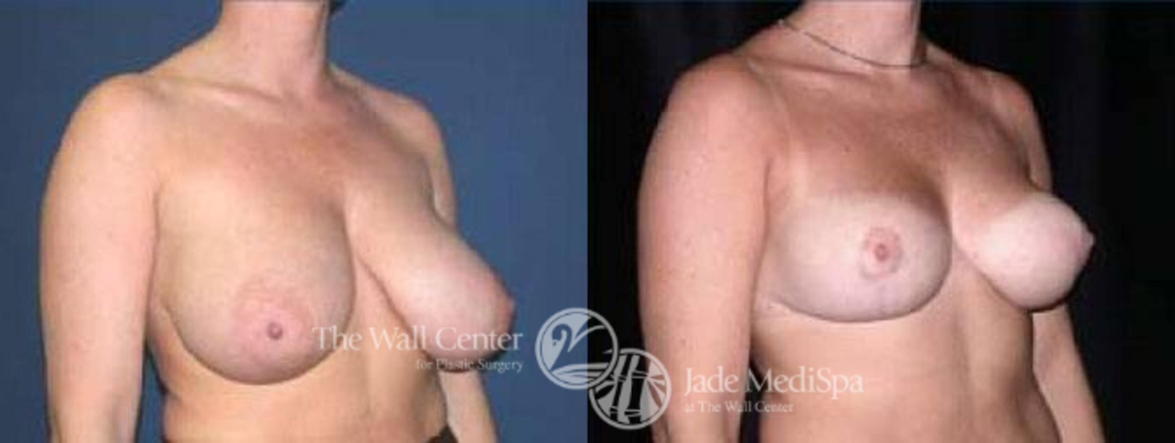 Before & After Breast Reduction Case 69 View #2 View in Shreveport, LA
