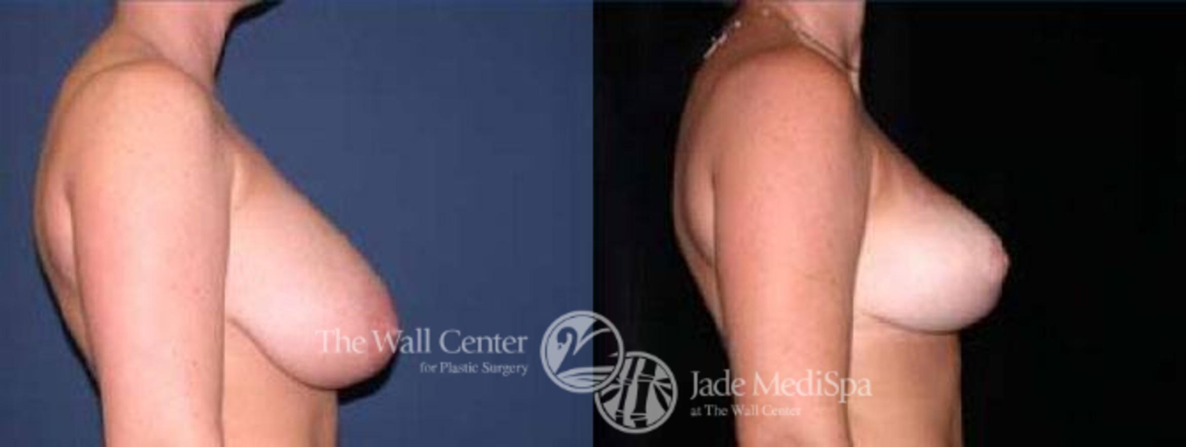 Before & After Breast Reduction Case 69 View #3 View in Shreveport, LA