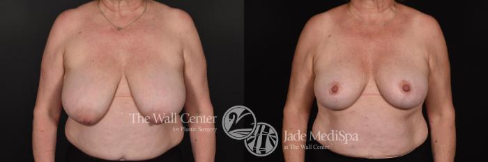 Before & After Breast Lift Case 699 VIEW #1 View in Shreveport, LA