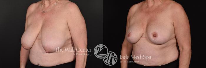 Before & After Breast Reduction Case 699 VIEW #2 View in Shreveport, LA