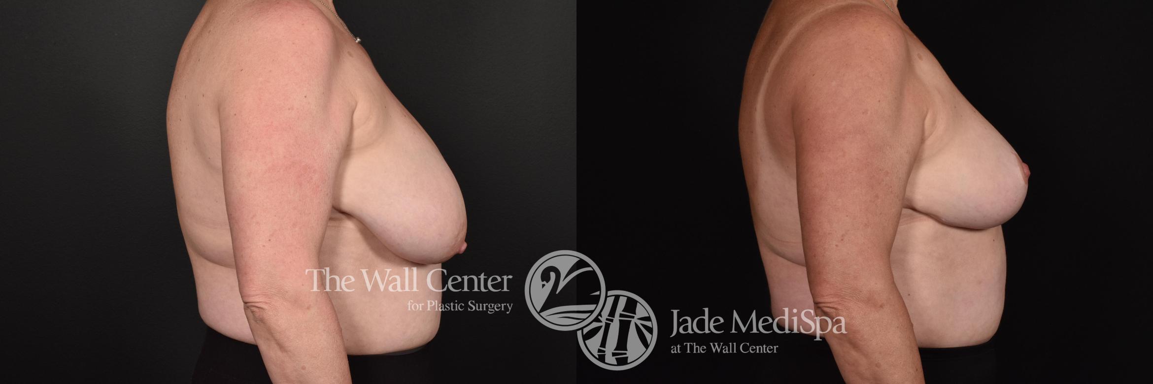 Before & After Breast Lift Case 699 VIEW #3 View in Shreveport, LA