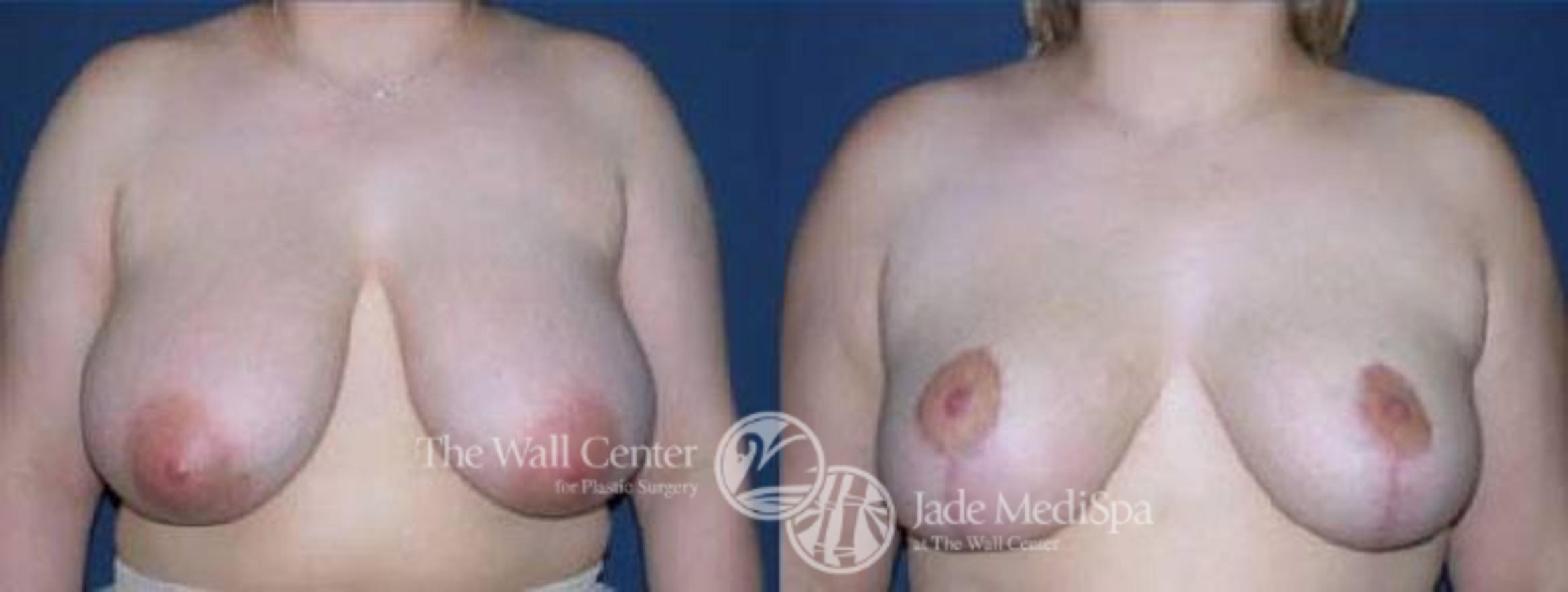 Before & After Breast Reduction Case 70 View #1 View in Shreveport, LA