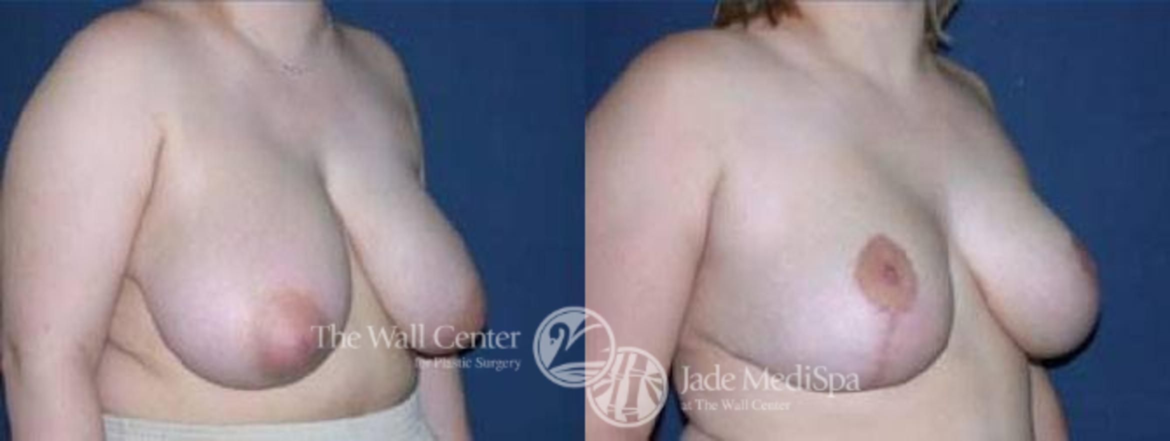 Before & After Breast Reduction Case 70 View #2 View in Shreveport, LA
