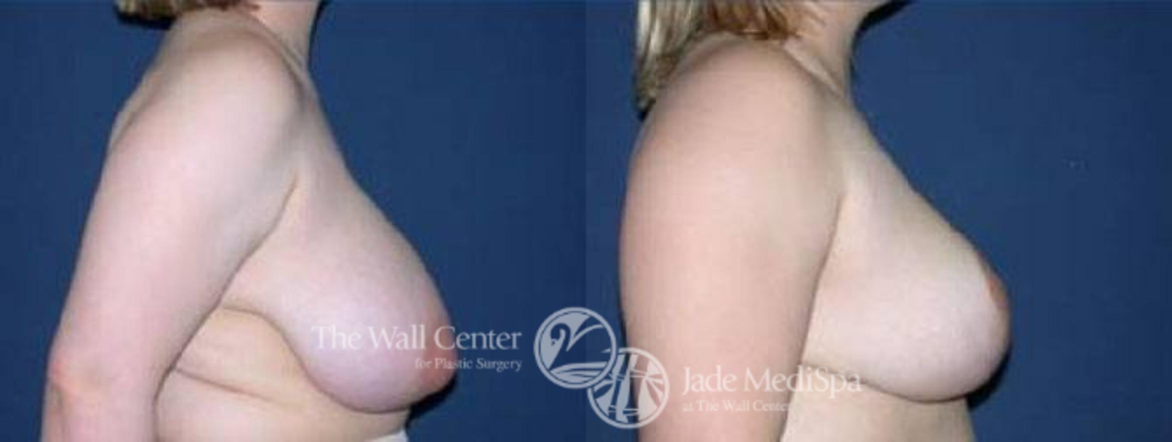 Before & After Breast Reduction Case 70 View #3 View in Shreveport, LA