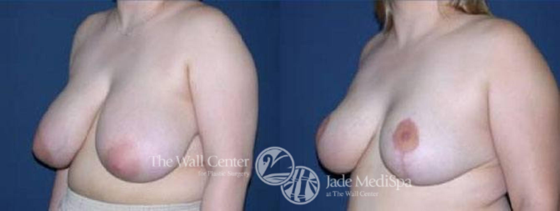 Before & After Breast Reduction Case 70 View #4 View in Shreveport, LA