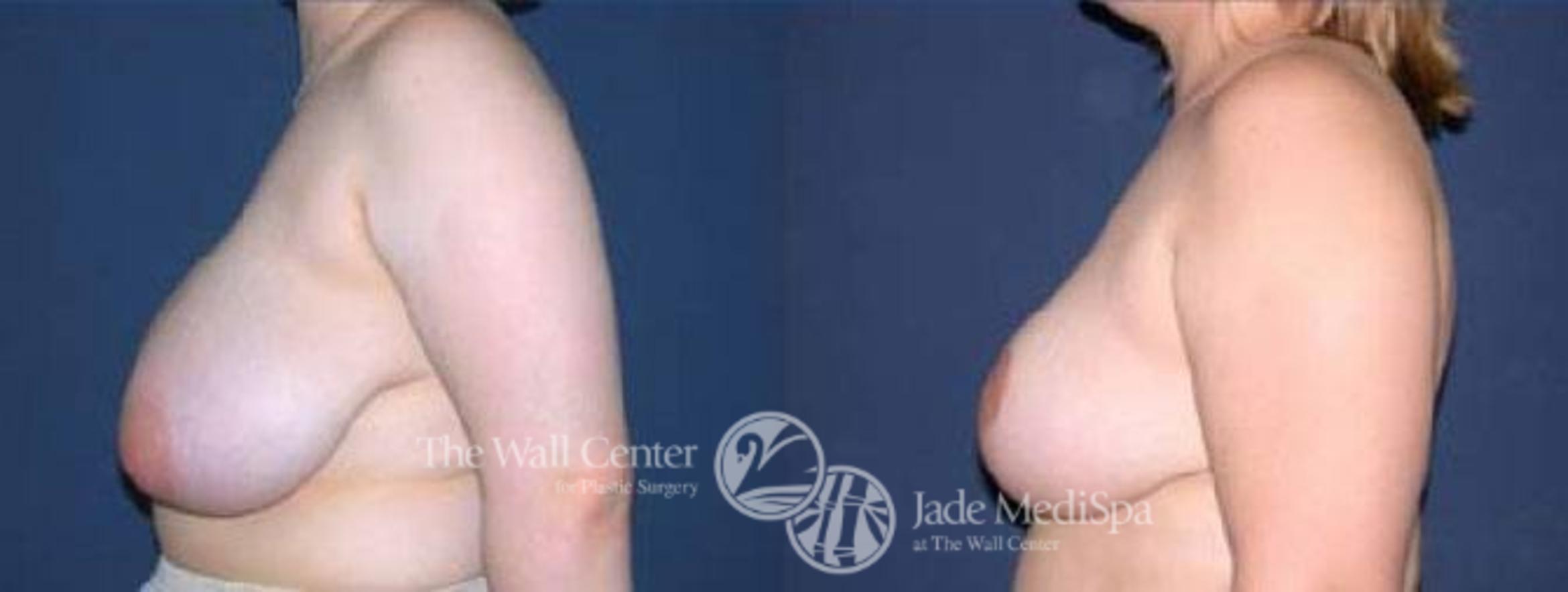 Before & After Breast Reduction Case 70 View #5 View in Shreveport, LA