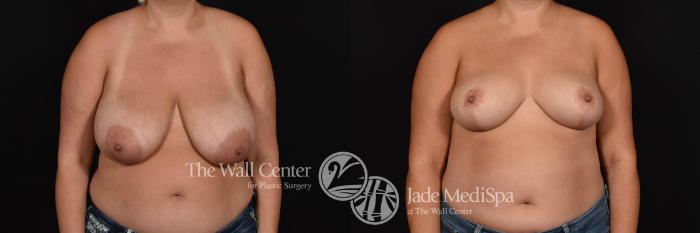 Before & After Breast Lift Case 788 VIEW #1 View in Shreveport, LA