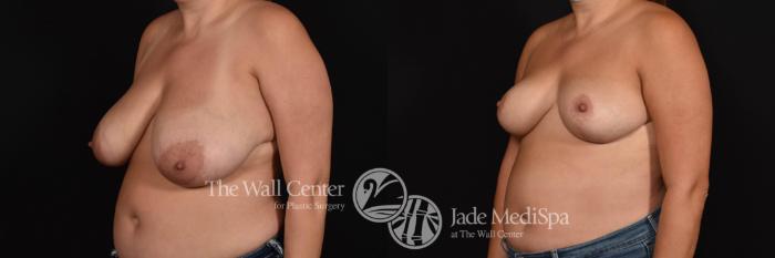 Before & After Breast Reduction Case 788 VIEW #2 View in Shreveport, LA