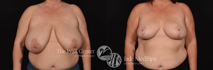 Breast Reduction Front Photo, Shreveport, Louisiana, The Wall Center for Plastic Surgery, Case 853