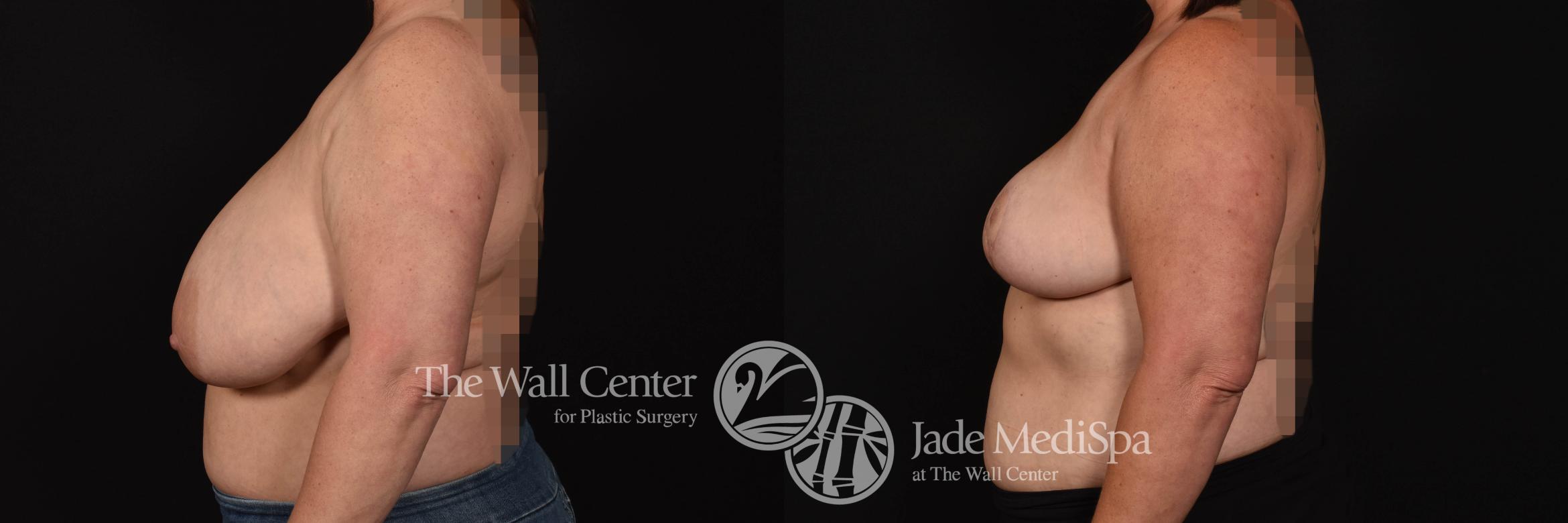 Breast Reduction Left Side Photo, Shreveport, Louisiana, The Wall Center for Plastic Surgery, Case 853
