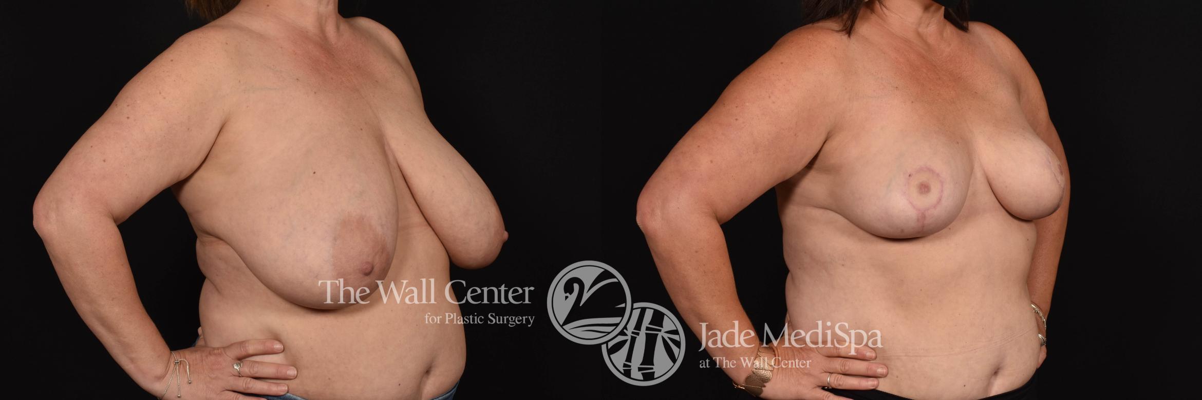 Breast Reduction Right Oblique Photo, Shreveport, Louisiana, The Wall Center for Plastic Surgery, Case 853