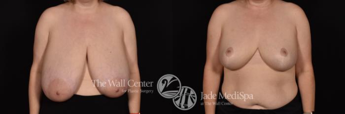 Breast Reduction Front Photo, Shreveport, Louisiana, The Wall Center for Plastic Surgery, Case 977