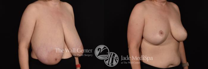 Breast Reduction Right Oblique Photo, Shreveport, Louisiana, The Wall Center for Plastic Surgery, Case 977