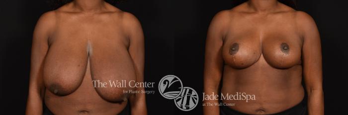Before & After Breast Reduction Case 996 Front View in Shreveport, LA