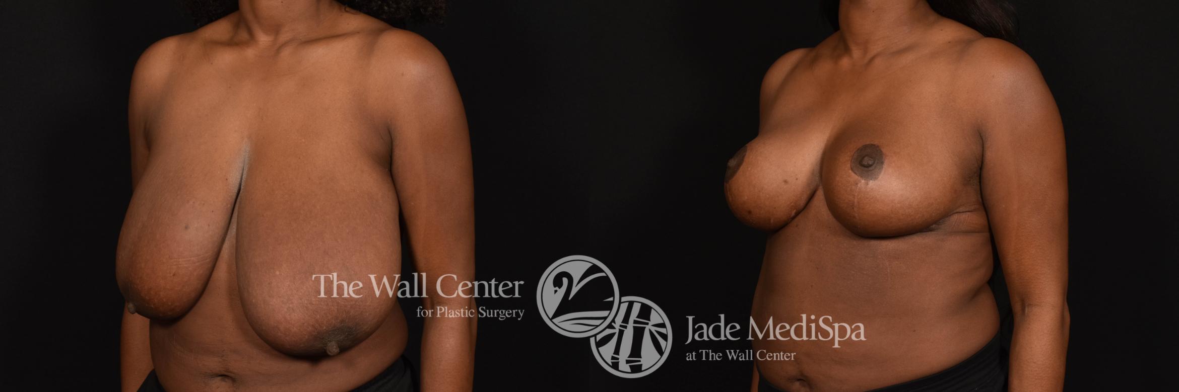 Before & After Breast Reduction Case 996 Left Oblique View in Shreveport, LA