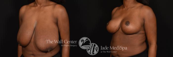 Before & After Breast Reduction Case 996 Left Oblique View in Shreveport, LA