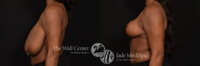 Before & After Breast Reduction Case 996 Left Side View in Shreveport, LA