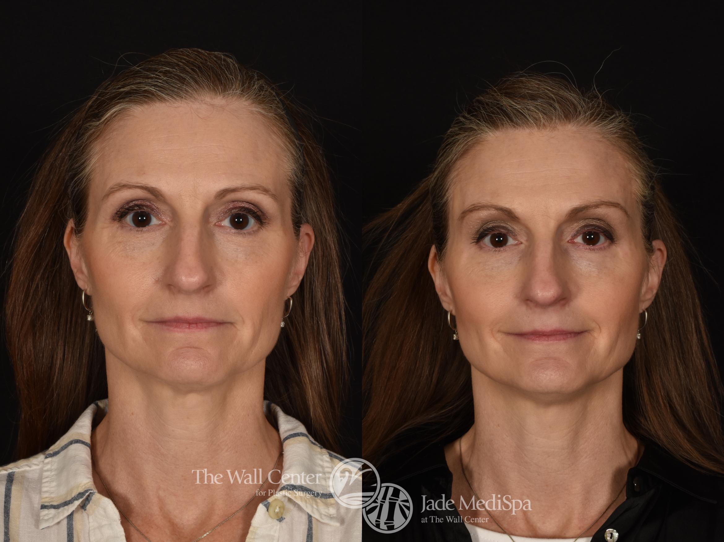 Before & After Brow Lift Case 1221 Front View in Shreveport, LA