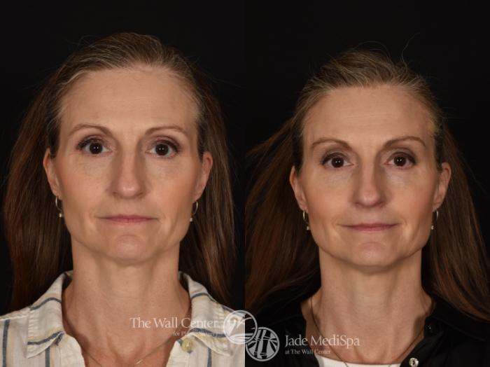 Before & After Brow Lift Case 1221 Front View in Shreveport, LA