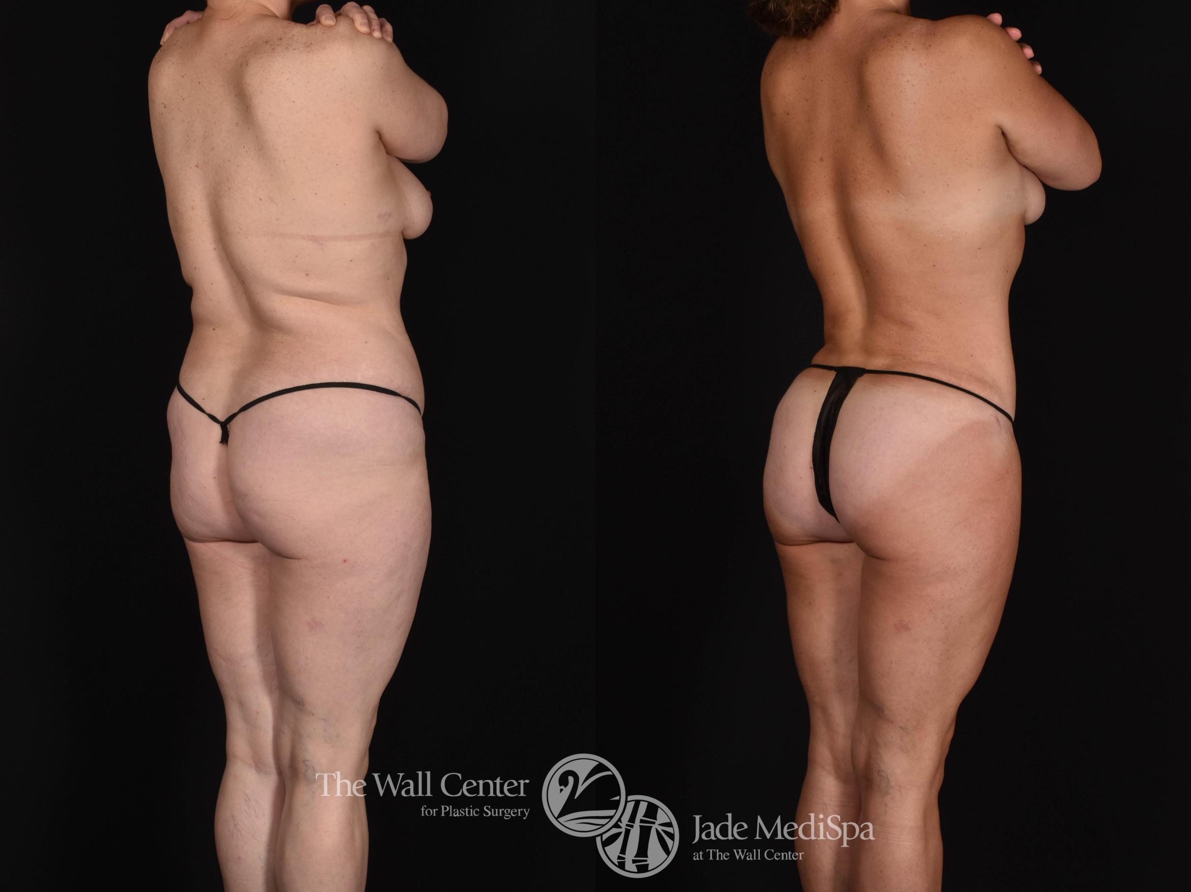 Before & After Tummy Tuck Case 723 VIEW #1 View in Shreveport, LA