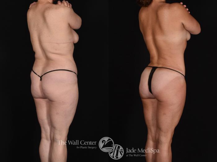 Before & After Buttock Augmentation Case 723 VIEW #1 View in Shreveport, LA