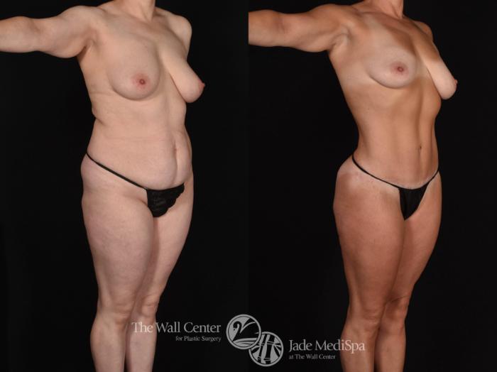 Before & After Fat Grafting – Buttocks Case 723 VIEW #2 View in Shreveport, LA