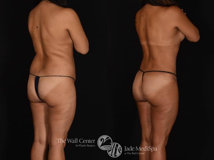 Before & After Fat Grafting – Buttocks Case 785 VIEW #1 View in Shreveport, LA