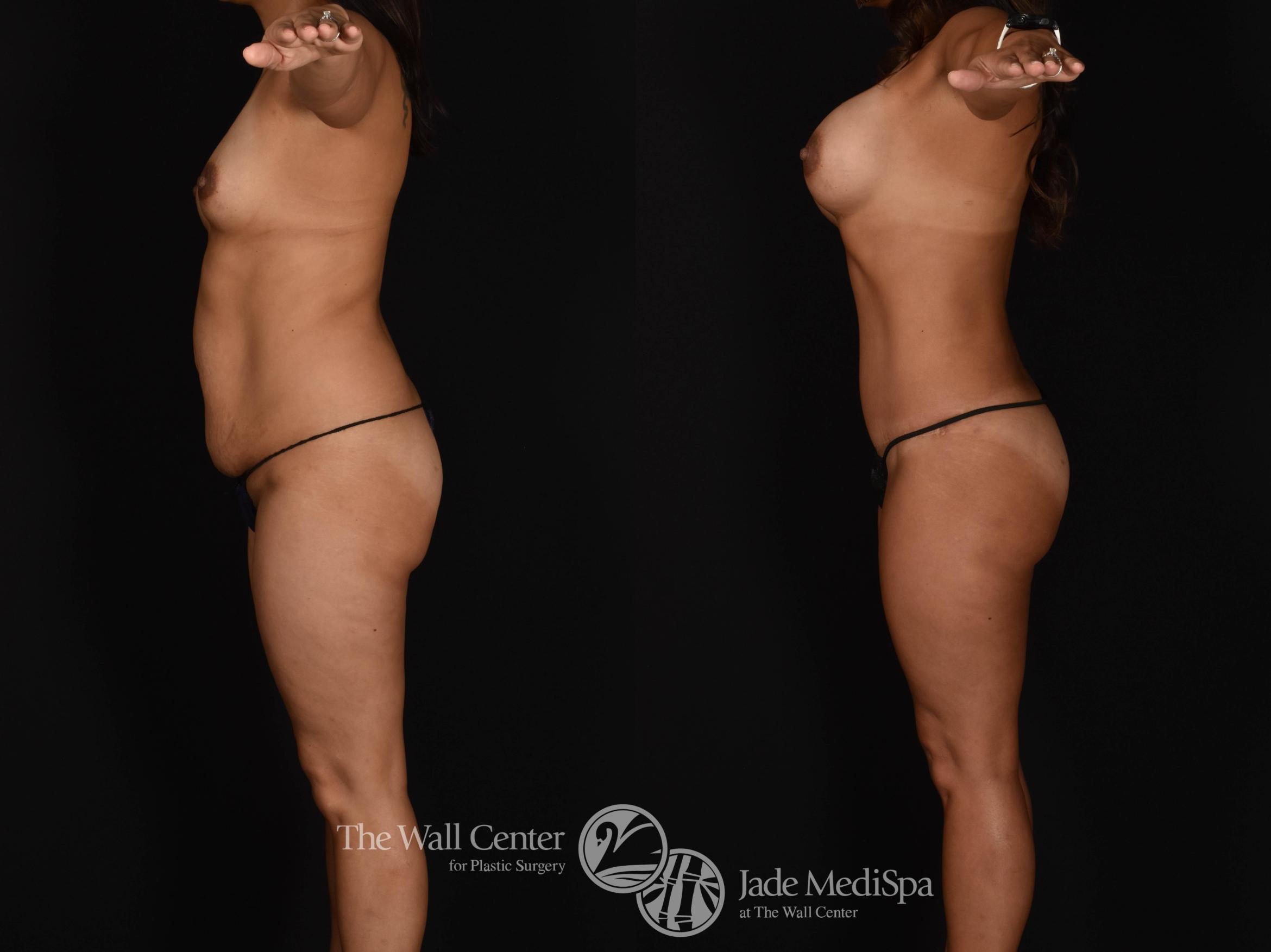 Before & After Buttock Augmentation Case 785 VIEW #2 View in Shreveport, LA