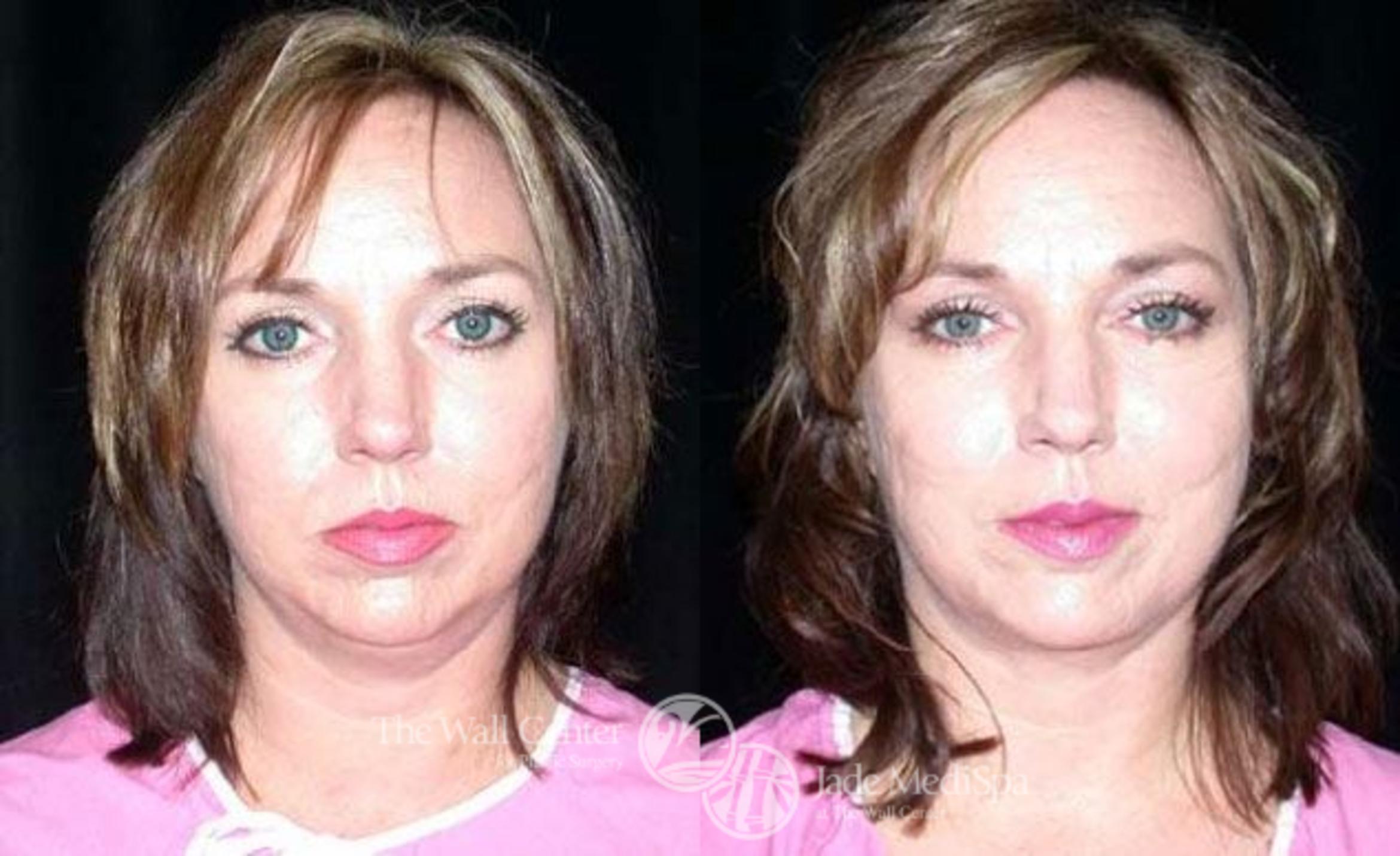 Before & After Cheek/Chin Augmentation Case 187 View #1 View in Shreveport, LA
