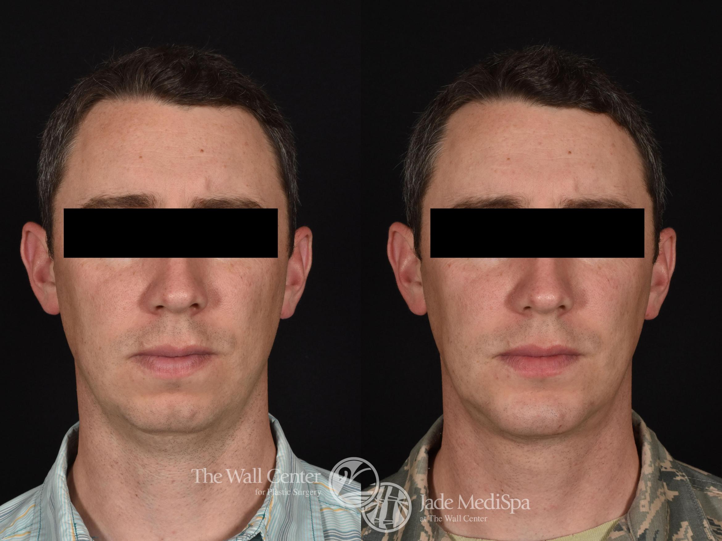 Before & After Cheek/Chin Augmentation Case 684 VIEW #1 View in Shreveport, LA