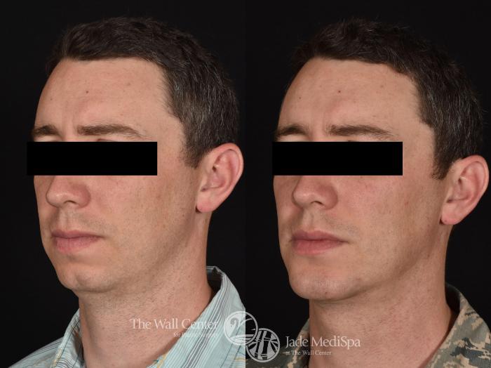 Before & After Cheek/Chin Augmentation Case 684 VIEW #2 View in Shreveport, LA