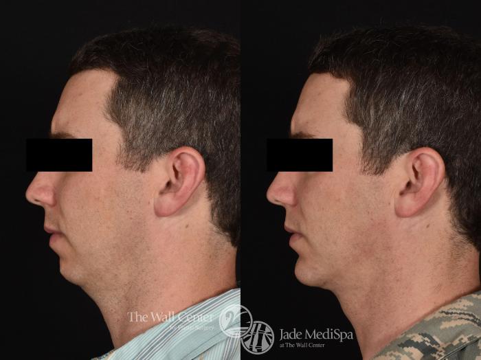 Before & After Cheek/Chin Augmentation Case 684 VIEW #3 View in Shreveport, LA