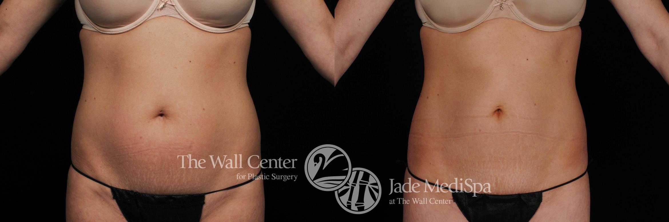 Before & After CoolSculpting Case 452 View #1 View in Shreveport, LA
