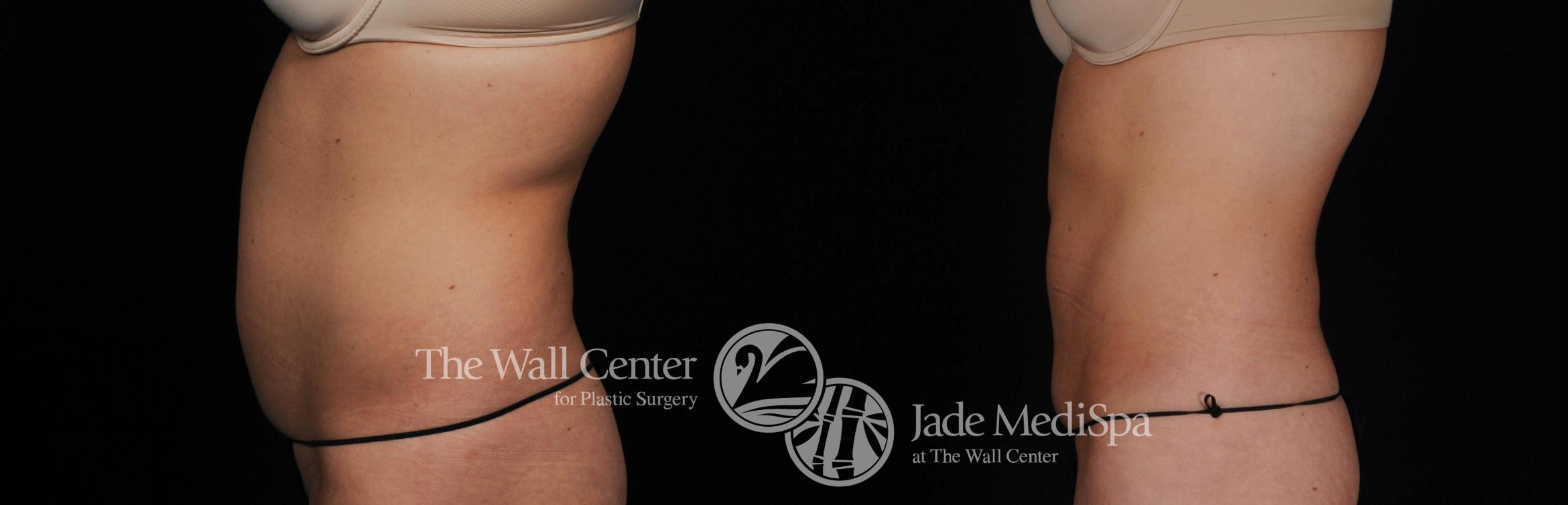 Before & After CoolSculpting Case 452 View #2 View in Shreveport, LA