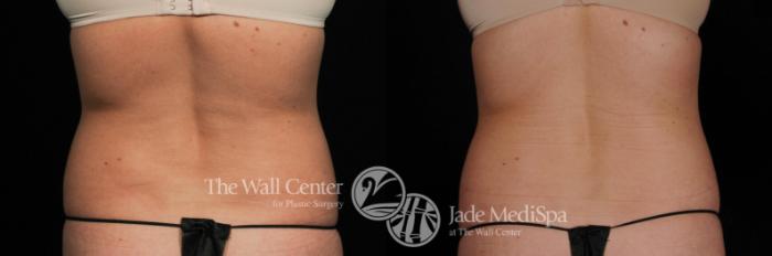 Before & After CoolSculpting Case 452 View #3 View in Shreveport, LA