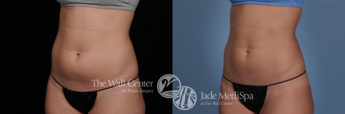 Before & After CoolSculpting Case 484 View #1 View in Shreveport, LA