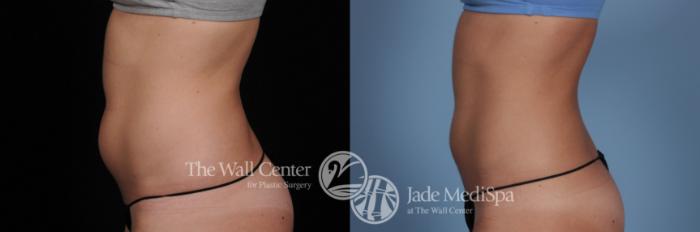 Before & After CoolSculpting Case 484 View #2 View in Shreveport, LA