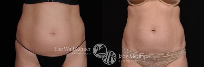 CoolSculpting Before and After 80
