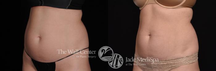 Before & After CoolSculpting Case 527 View #2 View in Shreveport, LA