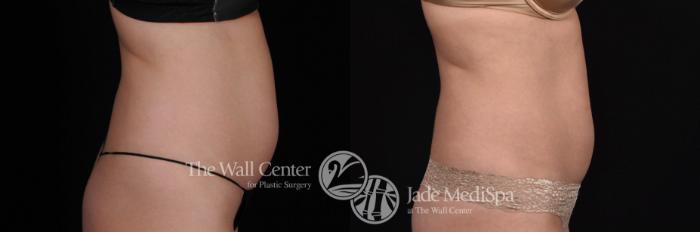 Before & After CoolSculpting Case 527 View #3 View in Shreveport, LA