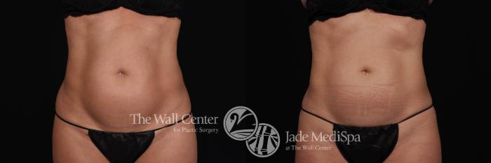 Before & After CoolSculpting Case 528 View #1 View in Shreveport, LA