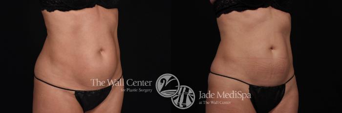 Before & After CoolSculpting Case 528 View #2 View in Shreveport, LA