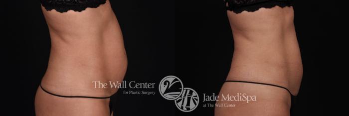 Before & After CoolSculpting Case 528 View #3 View in Shreveport, LA