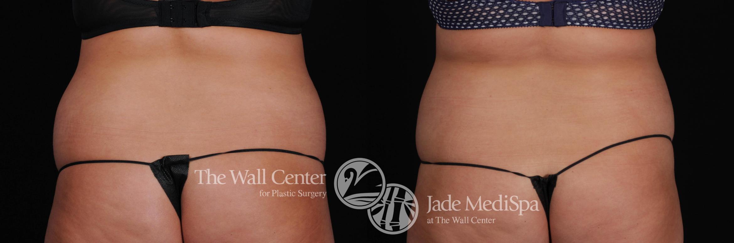Before & After CoolSculpting Case 529 View #1 View in Shreveport, LA