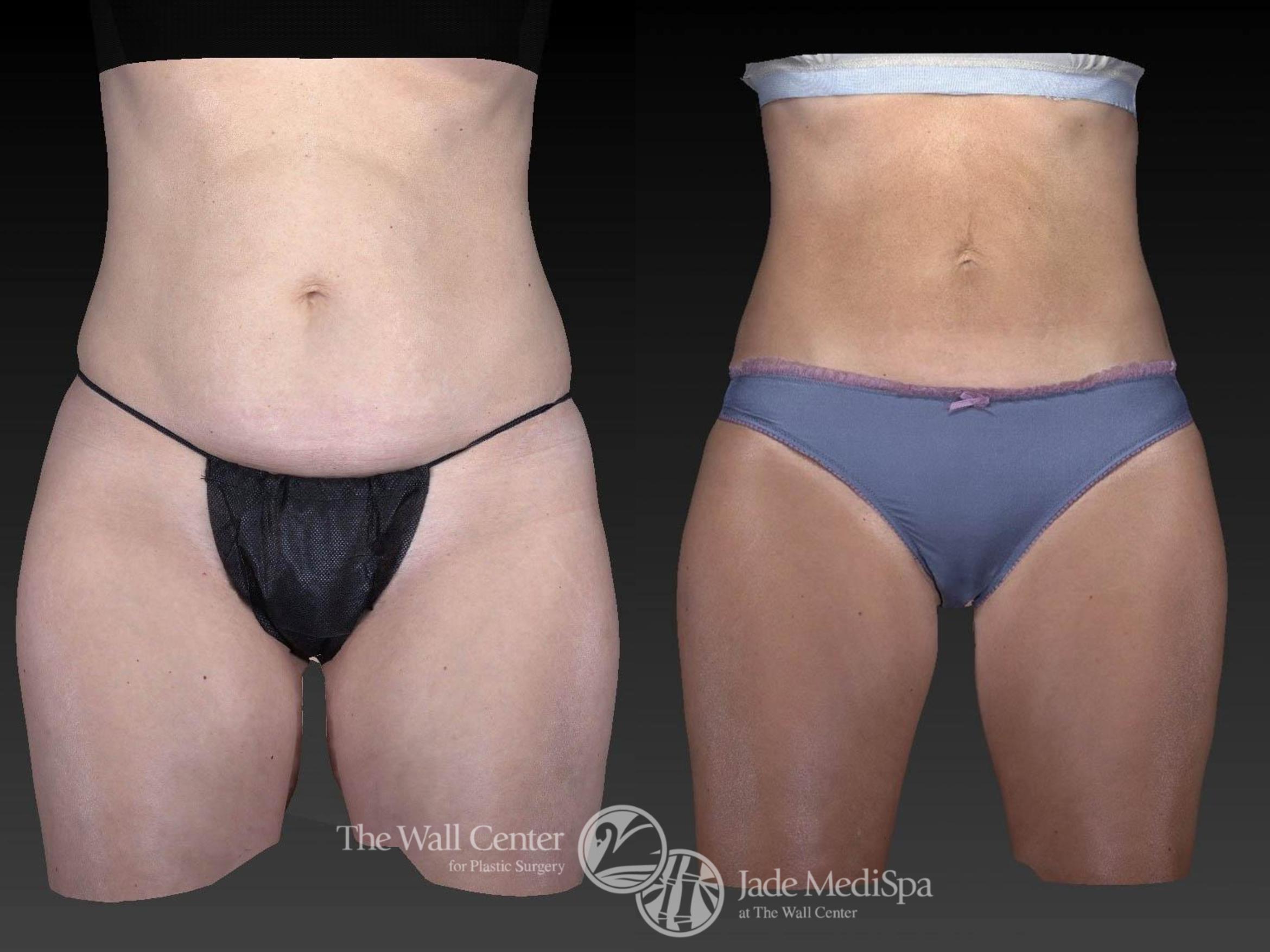 Before & After CoolSculpting Case 530 View #1 View in Shreveport, LA